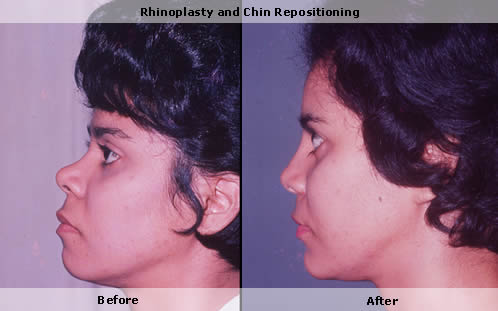 Chin enhancement, rhinoplasty